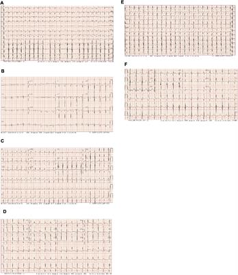 Case report: Efficacy analysis of radiofrequency catheter ablation combined with atrial appendage resection for atrial tachycardia originating from the atrial appendage in children